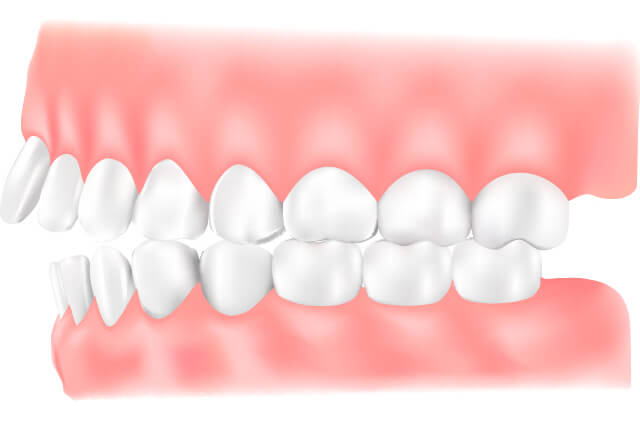 出っ歯（上顎前突：じょうがくぜんとつ）のイラスト
