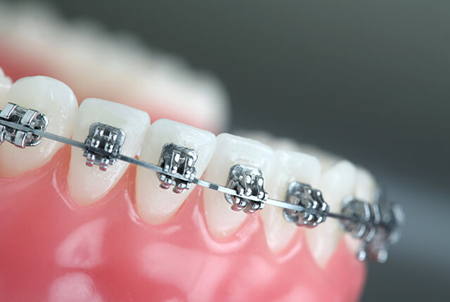 歯の矯正装置の画像