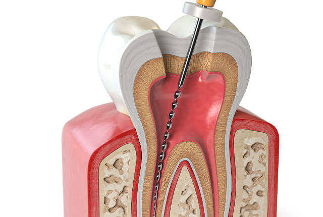 歯の根管治療のイラスト