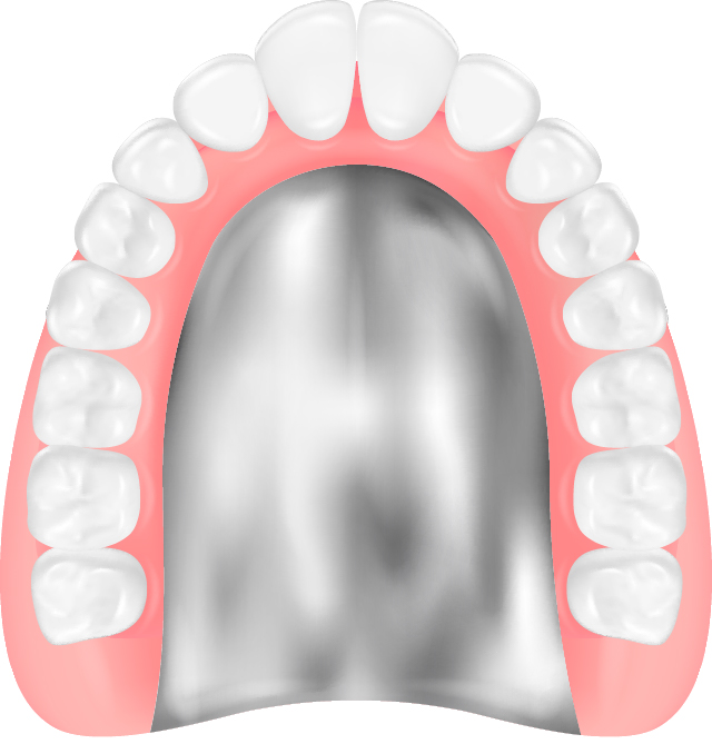 金属床義歯のイラスト