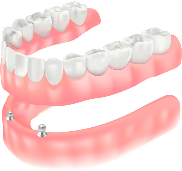 インプラントオーバーデンチャーのイラスト