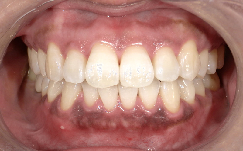 オフィスホワイトニング after