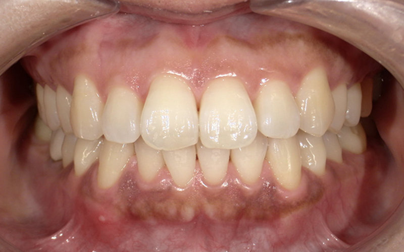 オフィスホワイトニング before