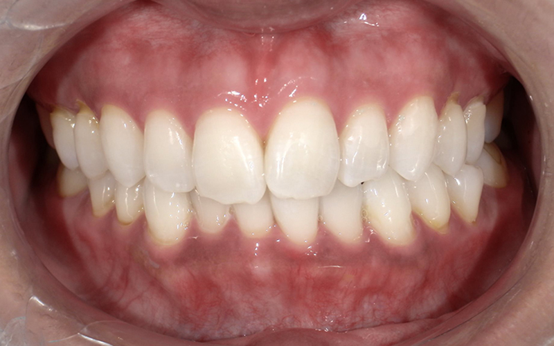 オフィスホワイトニング after