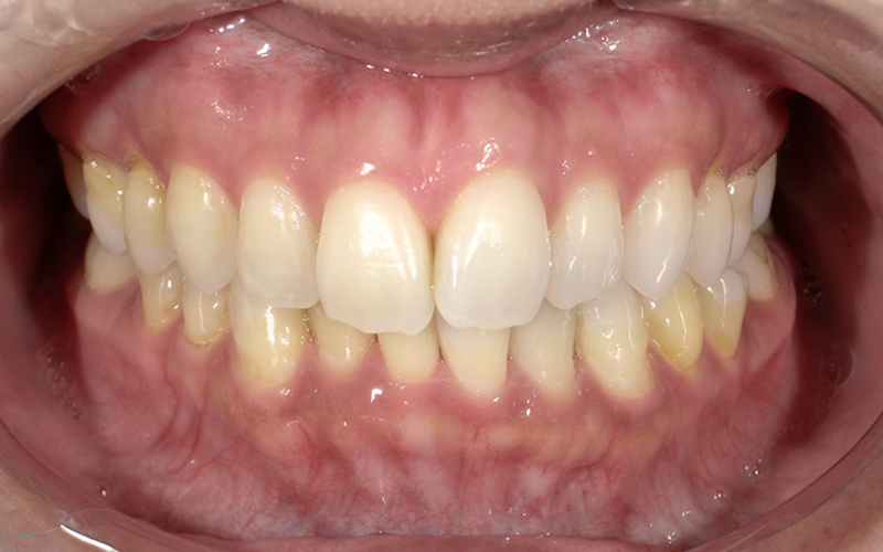 オフィスホワイトニング before