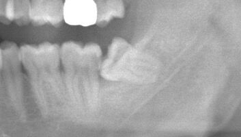 🦷
こんにちは、神保町ウィルデンタルオフィスです🏥
最近親知らずを抜歯される方が増えてきました！

親知らずは生え方によっては、抜歯をおすすめしています。
今回は抜いた方がいい親知らずのケースについて様々なレントゲン写真と共に説明していきます😊

◯歯茎から少し顔を出していて、手前の歯に引っかかっている場合
よくあるケースですが、親知らずが手前の歯に引っかかっていて、それ以上出てこられないものの、一部歯茎の上に頭が出ているケースです👀
この場合、歯磨きが難しいため歯茎が炎症を起こしたり、手前の歯との間に食べ物などが詰まりやすい、手前の歯を虫歯にしてしまうなど多くの問題が起こります🥲

◯深い歯周ポケットを作ってしまっている場合
親知らずが顔を出してないものの、歯茎の中で炎症を引き起こしており、歯周ポケットが深くなっているケースです。歯茎が腫れたり、膿がでてきたり、口臭の原因にもなります😵‍💫

◯大きな虫歯になっている場合
親知らずが虫歯になっている場合も抜歯が推奨されることがあります。しっかり噛み合っていない、生えている位置が悪く治療や歯ブラシによるケアが難しい場合などは抜歯をおすすめします😫

◯歯並びに影響を与えている可能性がある場合
親知らずが手前に向かって生えている場合、その力が手前の歯列に加わり、歯並びを崩してしまう可能性があります。この場合、矯正治療を検討の方などもあらかじめ親知らずを抜いておいた方がいいでしょう🥺

まとめ🦷
親知らずはしっかり生えていてブラッシングも行き届いてるのであれば、抜かない方がかみ合わせの負担のことも考えるといいと思います👌

親知らずが顔を出していて気になる方、痛みがある、抜いた方がいいのか判断がつかない場合などは一度歯医者を受診してチェックしてもらうようにしましょう🏥🦷

写真①左下親知らずが斜めに生えており、手前の歯の深い位置で虫歯になっている。

写真②左上の親知らずが大きな虫歯になっている

写真③右下の親知らずの周囲の骨が溶けてしまっている状態。嚢胞を形成している

写真④左右の親知らずが横向きに生えており、親知らず手前の奥歯が斜めに倒れてしまっている

写真⑤
写真④の下の歯並びの写真。左右の親知らずに押され、歯並びが崩れた可能性がある

#神保町ウィルデンタルオフィス #神保町 #駅近 #歯医者 #歯科医院 #新築 #新規open  #レントゲン　#オペ室 
#審美歯科治療 #歯列矯正 #歯周病 #口腔外科  #小児歯科  #ホワイトニング#お子様連れ歓迎  #バリアフリー#歯列矯正#矯正治療　#親知らず  #智歯 #抜歯